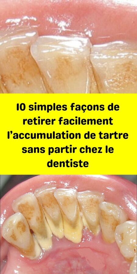 Illustration de clou de girofle utilisé en soin dentaire