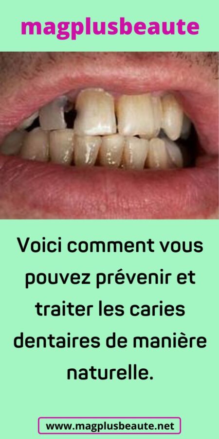 Illustration de clou de girofle utilisé en soin dentaire