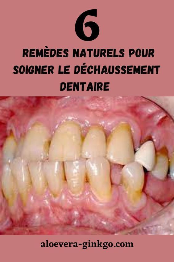 Photo de clou de girofle dent pour apaiser les maux