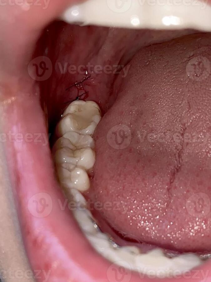 Soulager pression dents