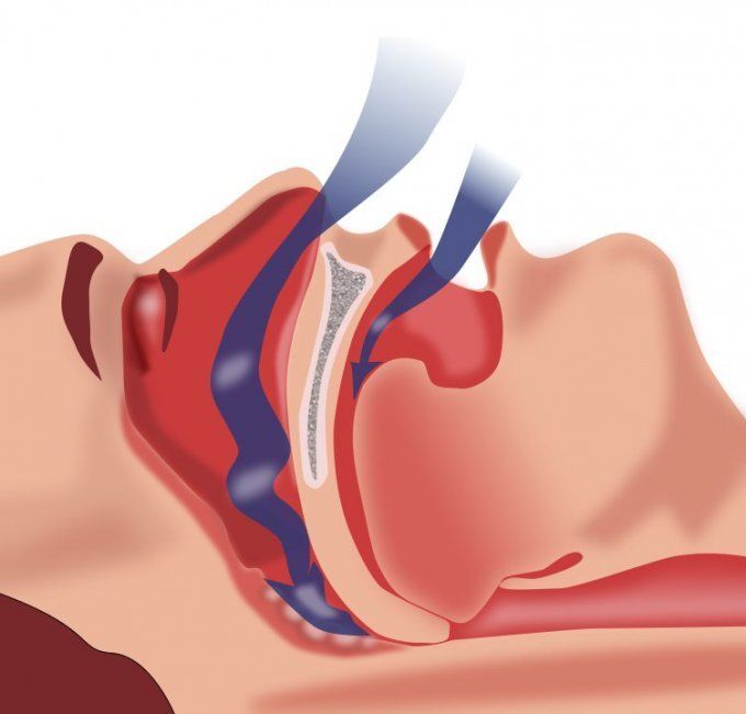 Solutions pour apnée du sommeil