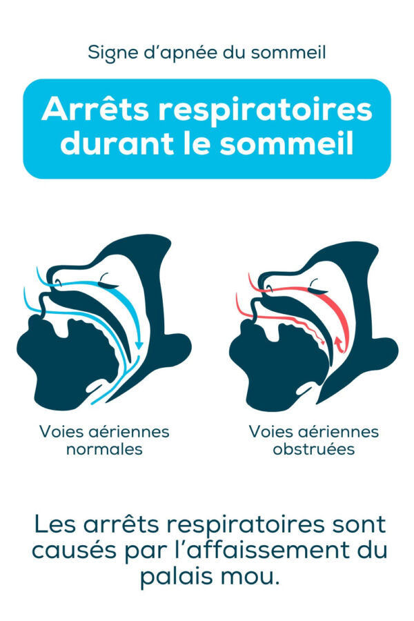 Signes apnée du sommeil