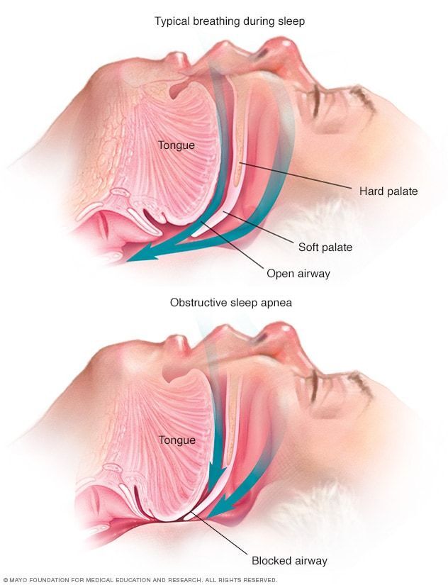 Signes apnée du sommeil