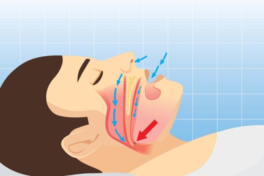 Solutions pour apnée du sommeil