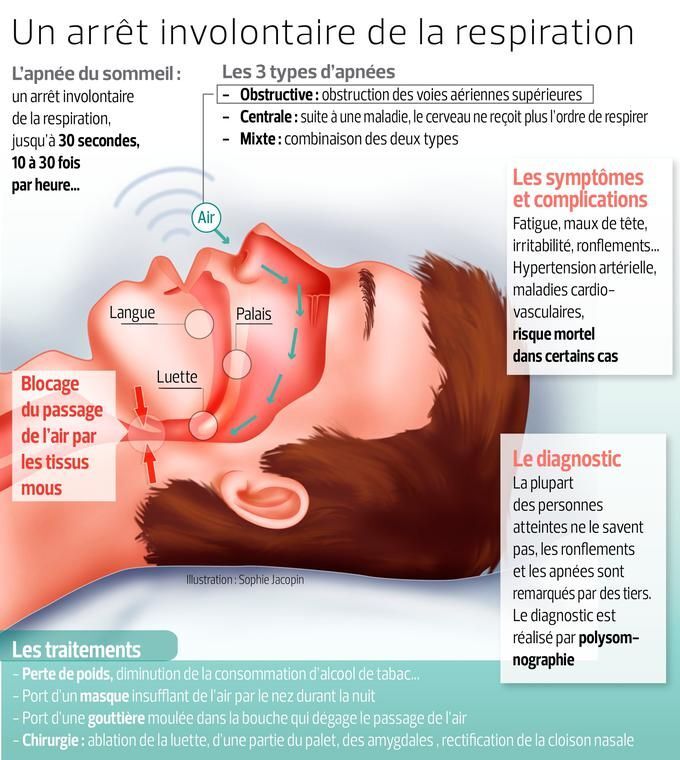 Signes apnée du sommeil