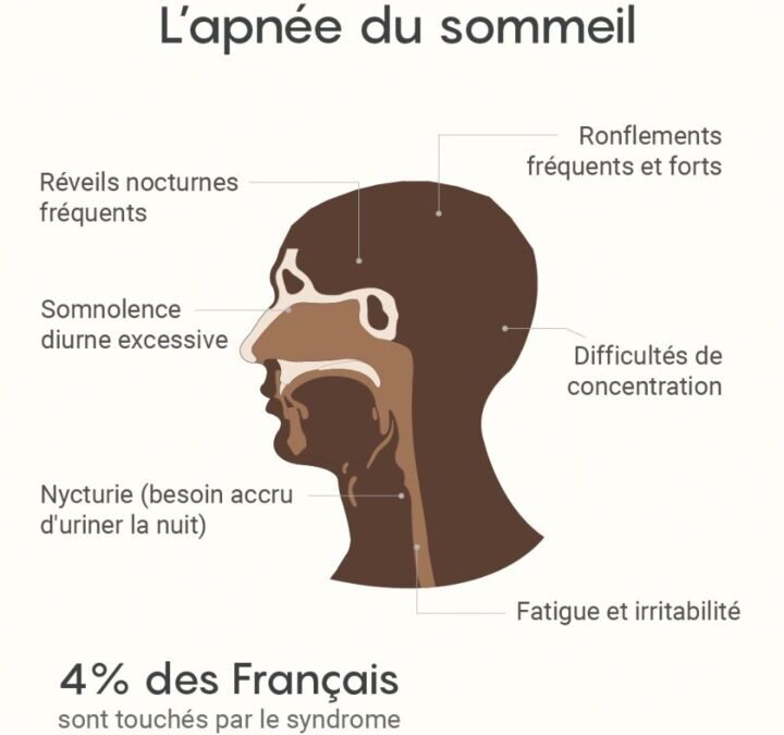 Les lourdes conséquences de l&rsquo;apnée du sommeil : causes et solutions concrètes