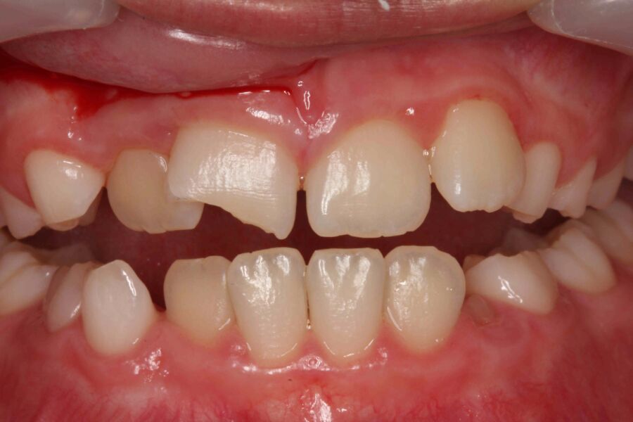 Solution pour dent cassée