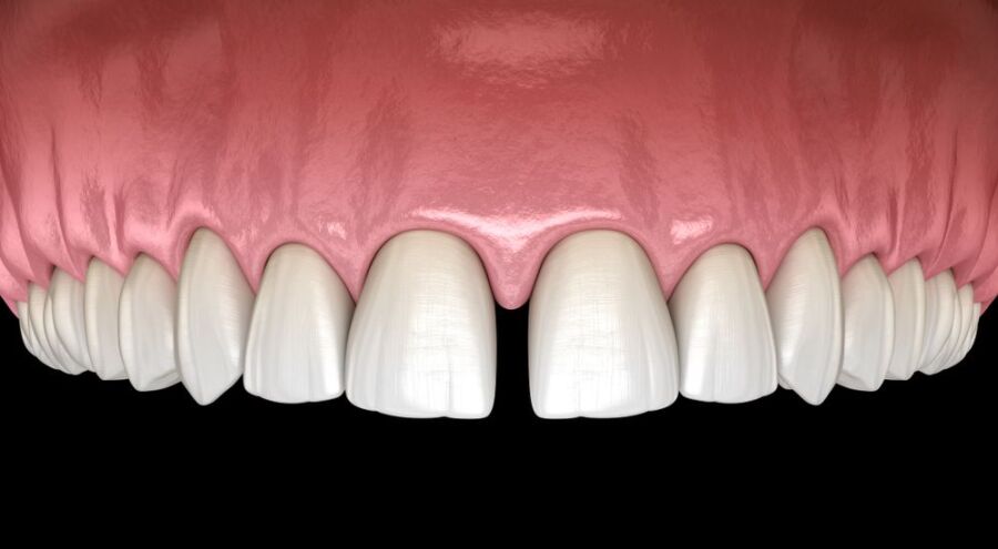 Solution pour dent cassée